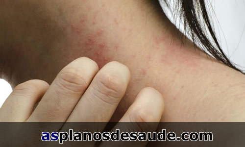 Dermatite! Descubra um pouco mais a respeito da doença!